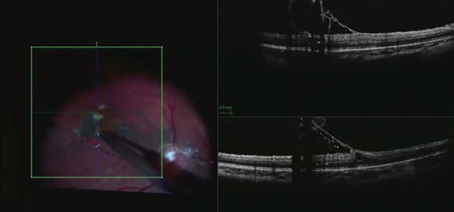 Intraoperative OCT showed the surgeon when to stop pulling to avoid amputating the epiretinal proliferation. Image courtesy of Robert A. Sisk, MD, FACS, Cincinnati Eye Institute.