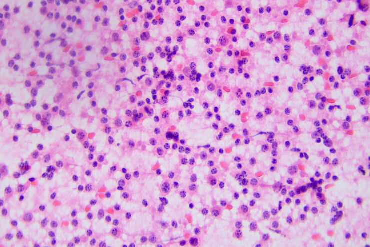 Acute lymphoblastic leukemia Acute lymphoblastic leukemia