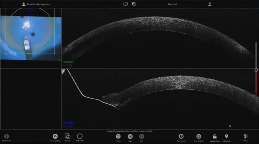 The intraoperative OCT supported the dissection of the cornea, with clear visualization of the tip of the blade. Images provided by Mr. David Anderson.