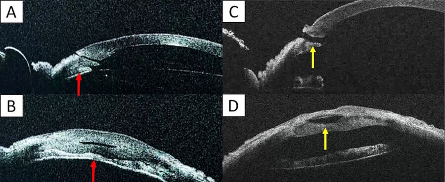 Figure 4: Incision architecture analysis at the end of the surgery. A and B: longitudinal and transversal scan of non-remodeled incision (red arrows). C and D: longitudinal and transversal scan of remodeled incision (red arrows), showing a more direct incision with an internal and an external gap.