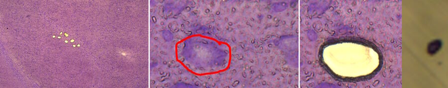 Fig. 2: Left: cresyl-violet-stained coronal murine midbrain section after UV-LMD of 10 individual DA neurons. Middle: selection for LMD of an individual neuron from the upper section. Right: after UV-LMD of the individual neuron section (left) and cap-control (right) demonstrating successful isolation. 