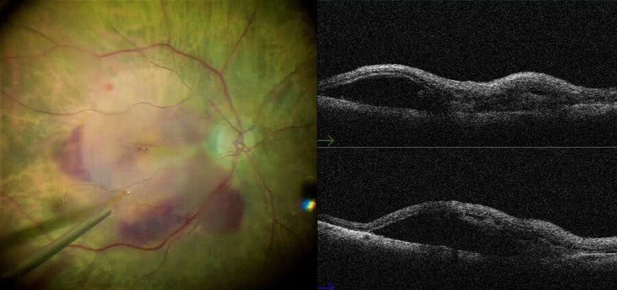 Fig. 10: Subretinal injection with a 36-gauge cannula. First, a balanced salt solution (BSS) was injected to detach the macular region, then, an anti-VEGF solution with TPA was injected in the same location. Finally, fluid air exchange with a 23-gauge cannula was performed and pneumatic displacement was carried out.