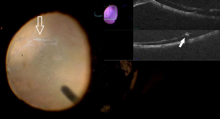 Fig. 9: A chronic retinal detachment with a subretinal fibrotic band (depicted by the white arrow). After core vitrectomy and posterior hyaloid detachment, the retina still hasn't completely settled and subretinal bands are observed. EnFocus intraoperative OCT image at top right of the monitor shows the subretinal fibrotic band (depicted by the arrowhead). Subretinal fibrosis was removed with 23-gauge forceps.
