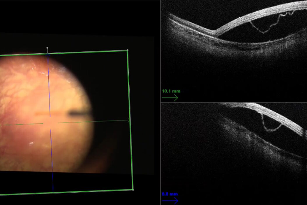 The intraoperative OCT showed the ellipsoid had separated from the inner retina with focal attachment to the retinal pigment epithelium (RPE). Images provided by Mr. Robert Henderson Ellipsoid_separated_from_the_inner_retina_with_focal_attachment_to_the_retinal_pigment_epithelium.jpg