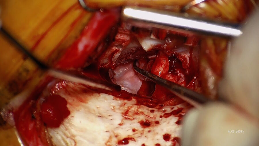 Figure 3: Insertion of the temporalis fascia graft. Image courtesy of Dr. Sean Flanagan