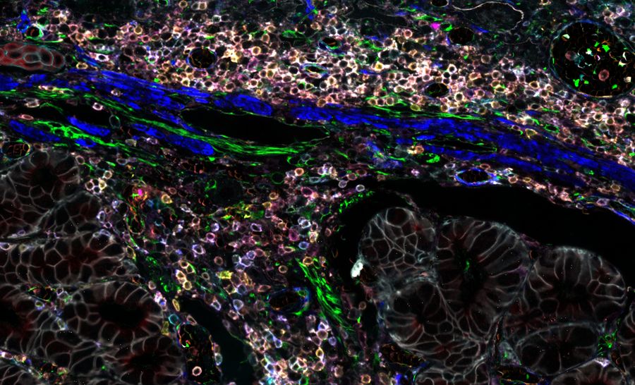 Pancreatic adenocarcinoma cancer immunity and progression imaged with Cell DIVE. 12 biomarkers shown: CD3, CD4, CD20, CD45, HLA1, SMA1, Vimentin, PCK26, NAK, Collagen, CD31, and CD8.