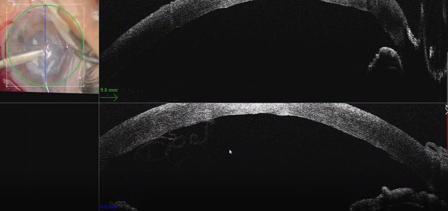 The intraoperative OCT is particularly helpful when there is a poor view, as in this case of ocular trauma, to visualize the separation of the Descemet’s membrane. Images provided by Mr. David Anderson.