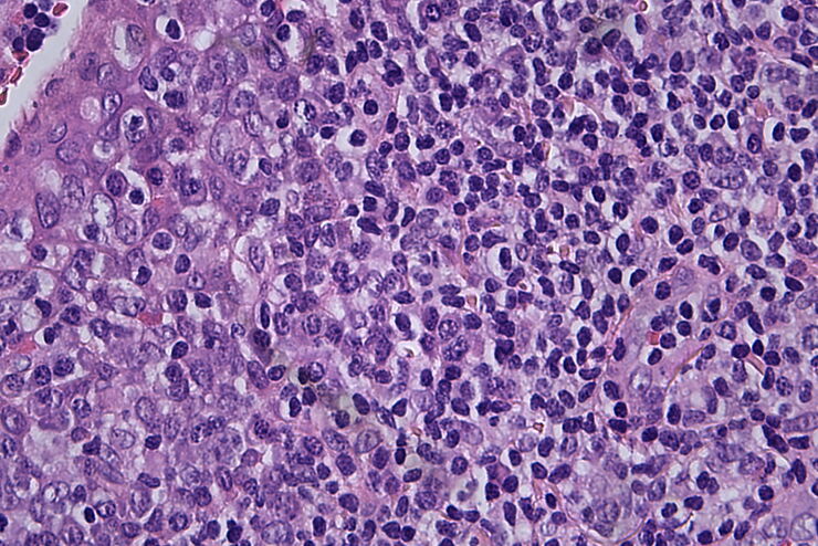 Histopathological sample, 40x magnification Histopathological sample, 40x magnification