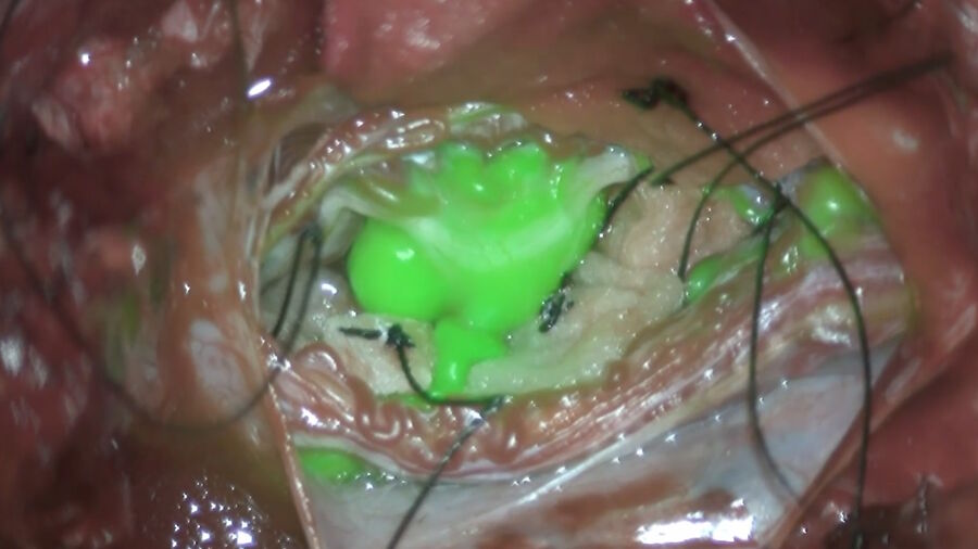 Solid tumor removal with GLOW800. Image courtesy of Dr. Christof Renner.