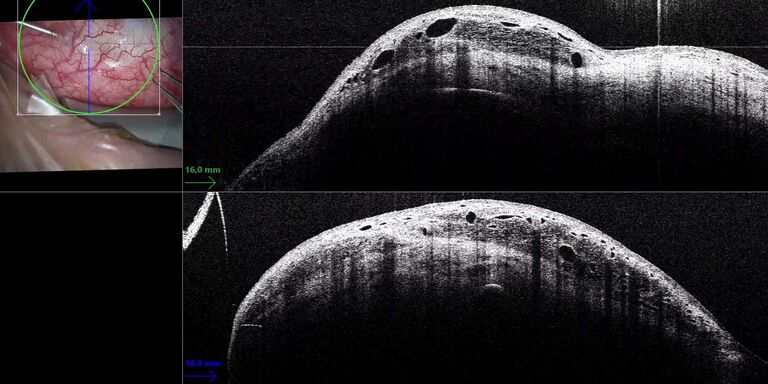 Intraoperative OCT picture showing 5-Fluorouracil (5-FU) drug injection after trabeculectomy. Images courtesy of Prof. Gerd Geerling, MD, PhD, FEBO, Department of Ophthalmology, University Hospital Düsseldorf, Germany