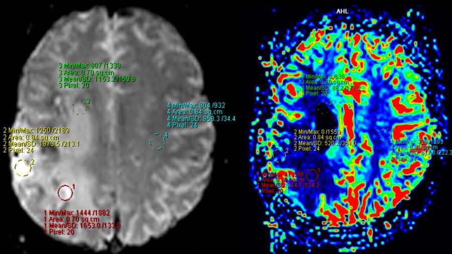 Brain perfusion MRI showing a decrease in perfusion in the right middle cerebral artery 