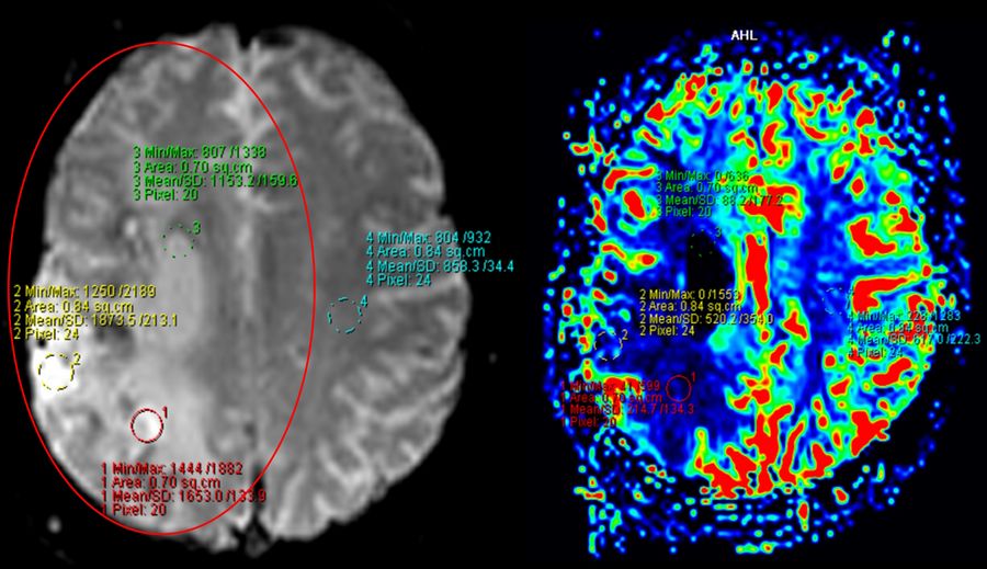 Brain perfusion MRI showing a decrease in perfusion in the right middle cerebral artery (MCA) territory.