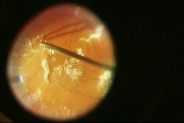 Integrazione di accessori per la chirurgia della retina