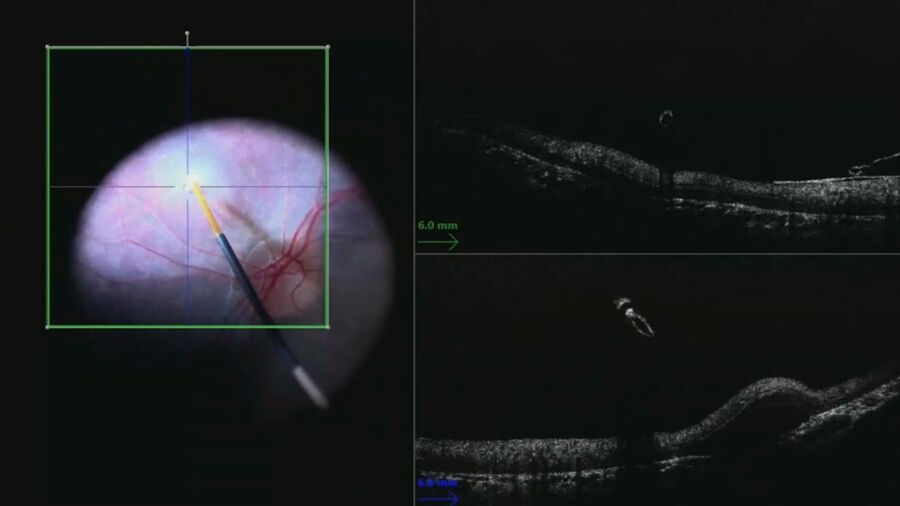 Figure 5: Second bleb created to apply treatment nasal to the optic nerve. Image courtesy of Robert A. Sisk, MD, FACS, Cincinnati Eye Institute.