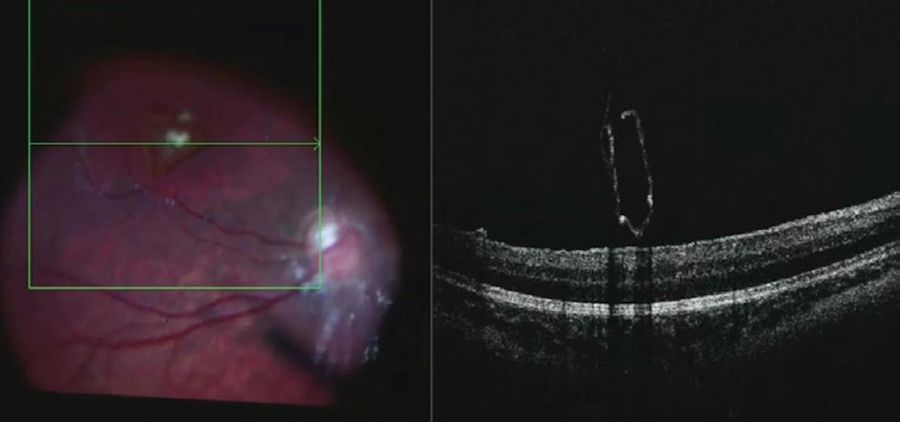 A final scan was performed to confirm traction was removed from the edges of the lamellar hole before the fluid air exchange. Image courtesy of Robert A. Sisk, MD, FACS, Cincinnati Eye Institute.