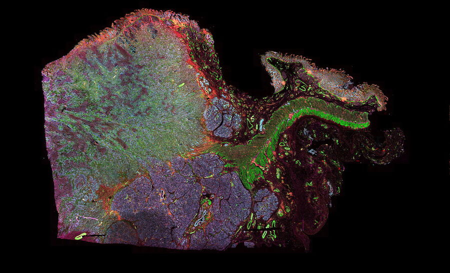 Pancreatic ductal adenocarcinoma tissue section imaged with Cell DIVE 