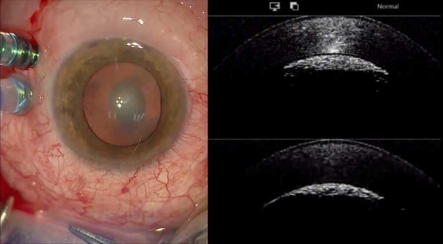 Silicone oil bubbles under the cornea.