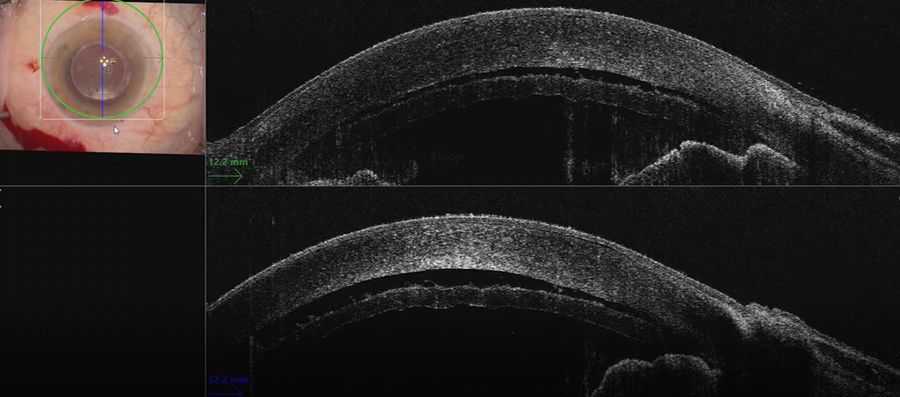The intraoperative OCT showed one of the grafts that had been introduced, helping to inform orientation through visualization of the stromal fibers and endothelium. Images provided by Mr. David Anderson.