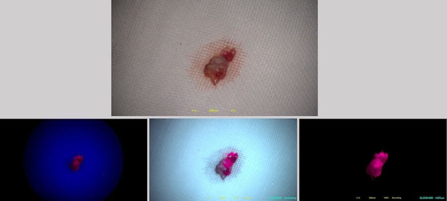 Fig. 2: Compared to the actual resected tumor (upper image) placed on top of a gauze, details including the gauze fibers can be seen in the bottom left image using conventional fluorescence and the bottom center image using the GLOW400 Anatomy view. The bottom right image uses the GLOW400 Highlighted Fluorescence view. Image courtesy of Prof. Kondo
