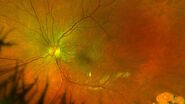 Fundus photo depicting epiretinal membrane with lamellar macular hole. Image courtesy of Robert A. Sisk, MD, FACS, Cincinnati Eye Institute. 