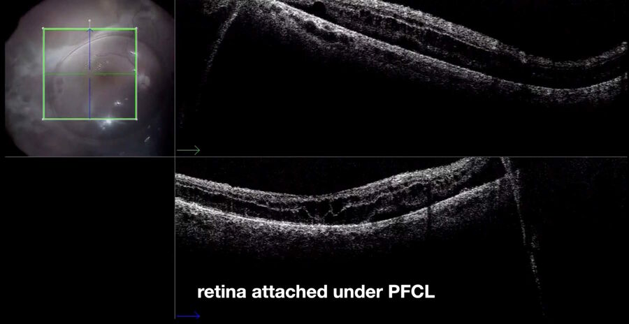 Intraoperative view of the same case as shown in Fig 11. The retina is attached under PFCL.