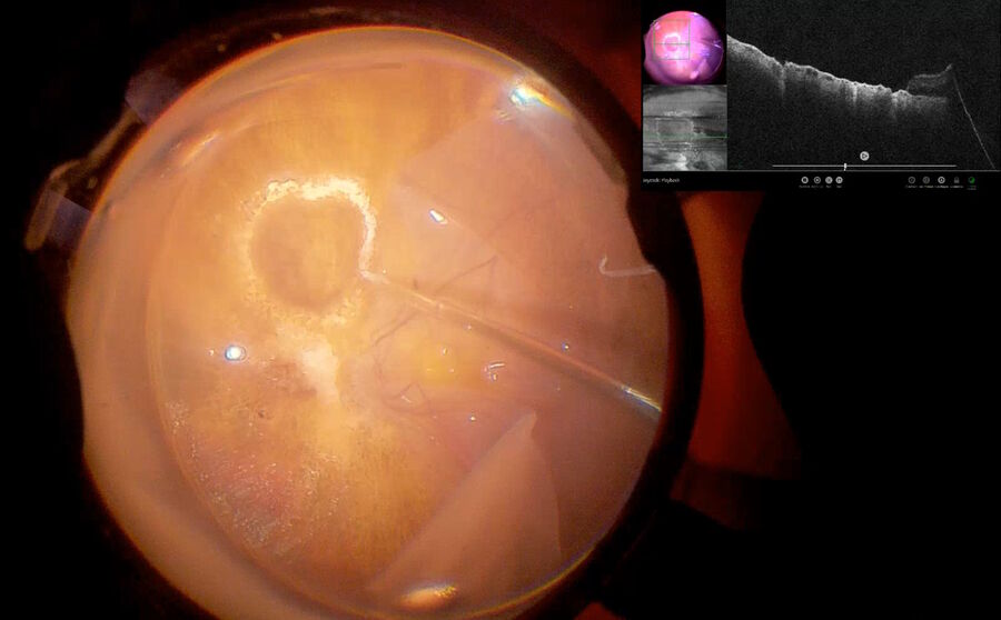 Fig. 12: After complete removal of vitreous core and base with 23-gauge vitrectomy, ILM peeling with 23-gauge forceps was performed. The temporal retina was folded onto the nasal retina and the RPE patch was created using endodiathermy. The EnFocus intraoperative OCT image scan shows the RPE and choriocapillaris on the autologous patch.
