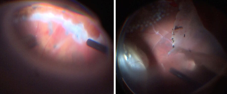 A retinotomy was performed and the retina was flipped over. Images provided by Prof. Nikolaos Bechrakis.