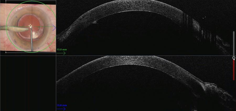 The EnFocus intraoperative OCT clearly showed the Descemet membrane peeling and endothelium. Images provided by Mr. David Anderson.