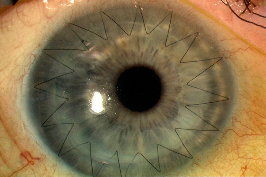 Corneal transplantation. Image courtesy of Mr. David Anderson. Corneal_transplantation.jpg