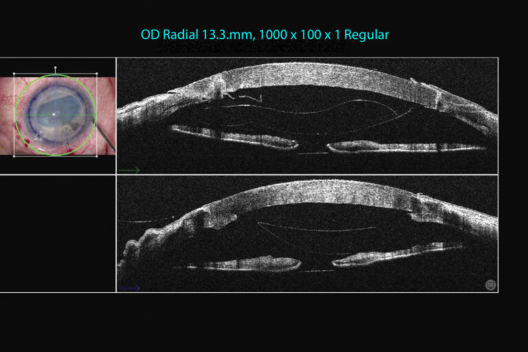 Courtesy of University Hospital Dusseldorf, Germany imaged with Proveo 8 and EnFocus