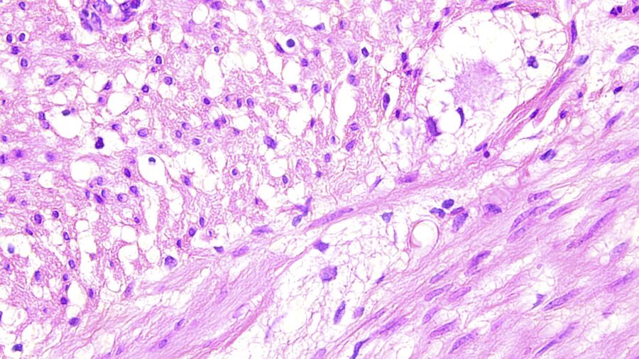 H&E stained tissue specimen.