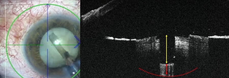 Figure 7: In the total cataract case, during the sculpting phase, intraoperative OCT is beneficial to access the depth of sculpting (yellow arrow) and the residual wall is clearly visible (red arrow).