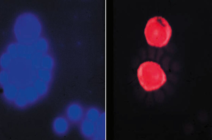 Human blood cells with "rosette" formation. Erythrocytes stained with the blue-fluorescent-stain stilbene using epi-illumination with UV light. Lymphocytes stained with the orange-red-stain eosine after excitation with green light 