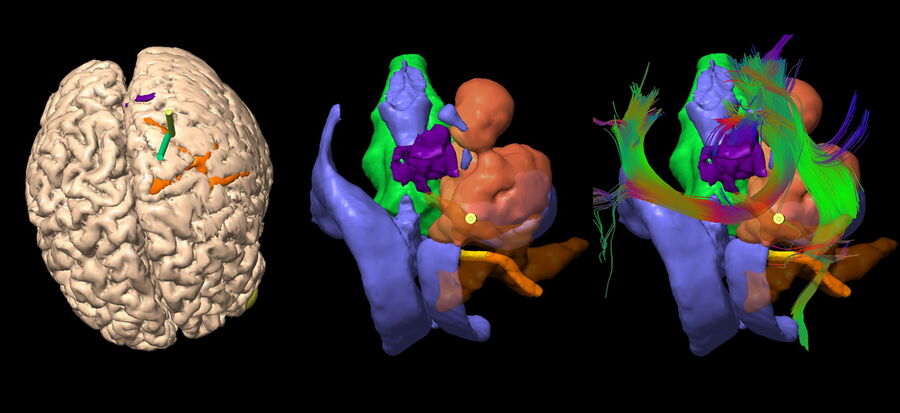 Patient positioning and trajectory design with Augmented Reality. Image courtesy of Prof. Philippe Bijlenga.