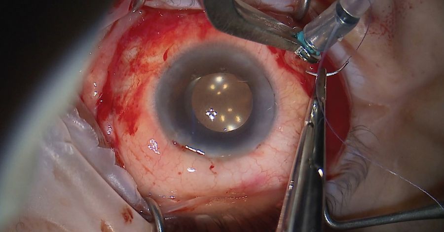 Closure of vitrectomy ports. Image courtesy of Arsham Sheybani, MD, Washington University School of Medicine.