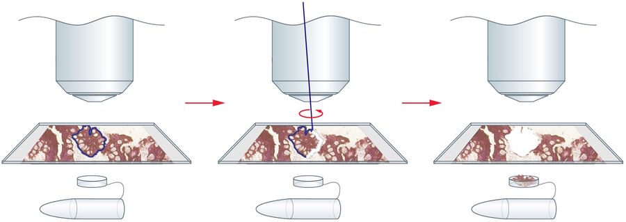 The Principle of laser microdissection (Leica Microsystems LMD system). Step 1: Defi ne region of interest. Step 2: Laser beam steered by optics along the cut line. Step 3: Specimen collection by gravity.