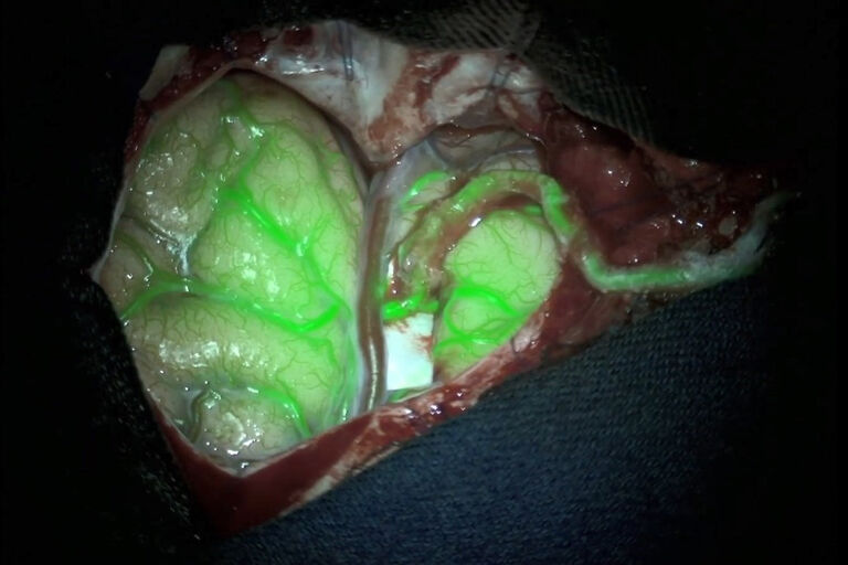 Aqui é mostrada uma cirurgia de bypass, verificando o fluxo sanguíneo e a perfusão do tecido. Imagem cortesia do Prof. Dr. Feres Chaddad, Chefe de Neurocirurgia Vascular da Universidade Federal de São Paulo, Brasil