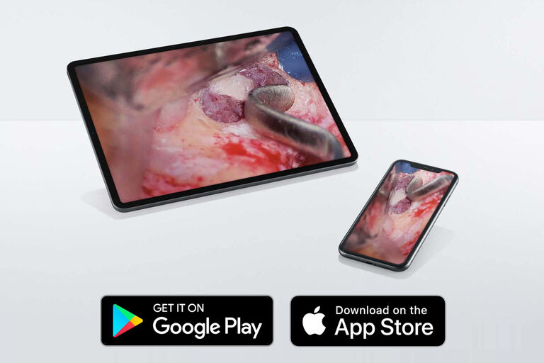 Streamen Sie Bilder und Videos des Dentalmikroskops M320 an mobile Endgeräte über die Leica View App. Dieses zahnmedizinische Bild zeigt einen Sinuslift. Bild mit freundlicher Genehmigung von Dr. Fabio Gorni, Mailand, Italien.

