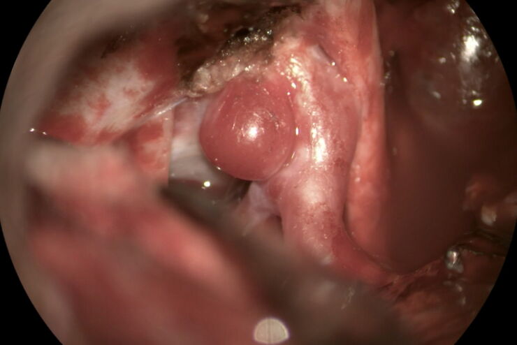 Intracranial Aneurysm Intracranial Aneurysm