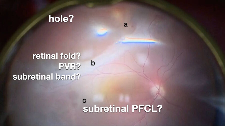 High magnification of the initial intraoperative view.