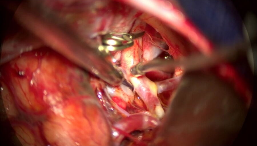 Microsurgical Clipping a cerebral aneurysm