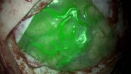Use of GLOW800 Augmented Reality during AVM surgery. Image courtesy of Prof. Philippe Bijlenga.