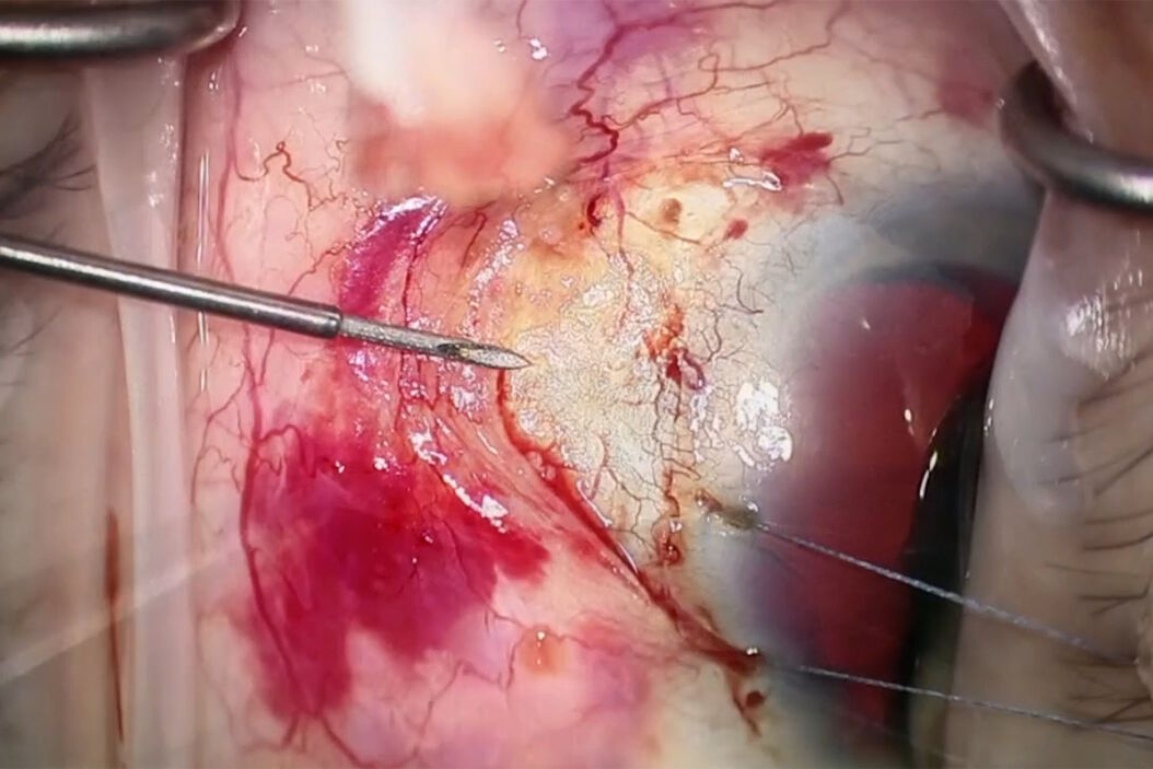 Dr. Sheybani places the new subconjunctival stent in the anterior chamber. Images courtesy of Arsham Sheybani, MD. Subconjunctival_stent_in_the_anterior_chamber.jpg