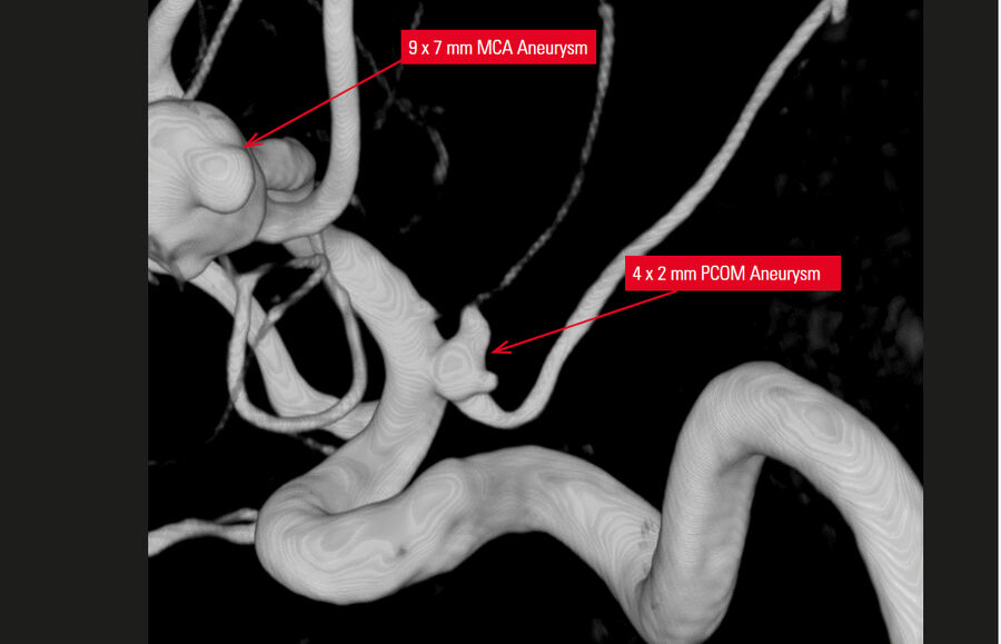 3D reconstruction showing both the MCA and PCOM aneurysms.