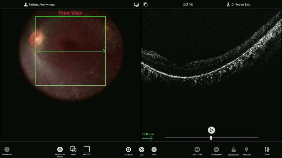 Macular scan performed to document the pre-injection anatomy. Images provided by Robert A. Sisk, MD, FACS .