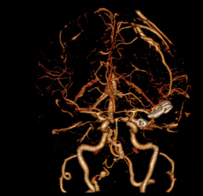 No flow into the clipped aneurysms confirmed on the 3D reconstruction.