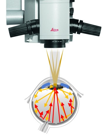 Creation of a stable red reflex thanks to CoAx 4, coaxial LED illumination.