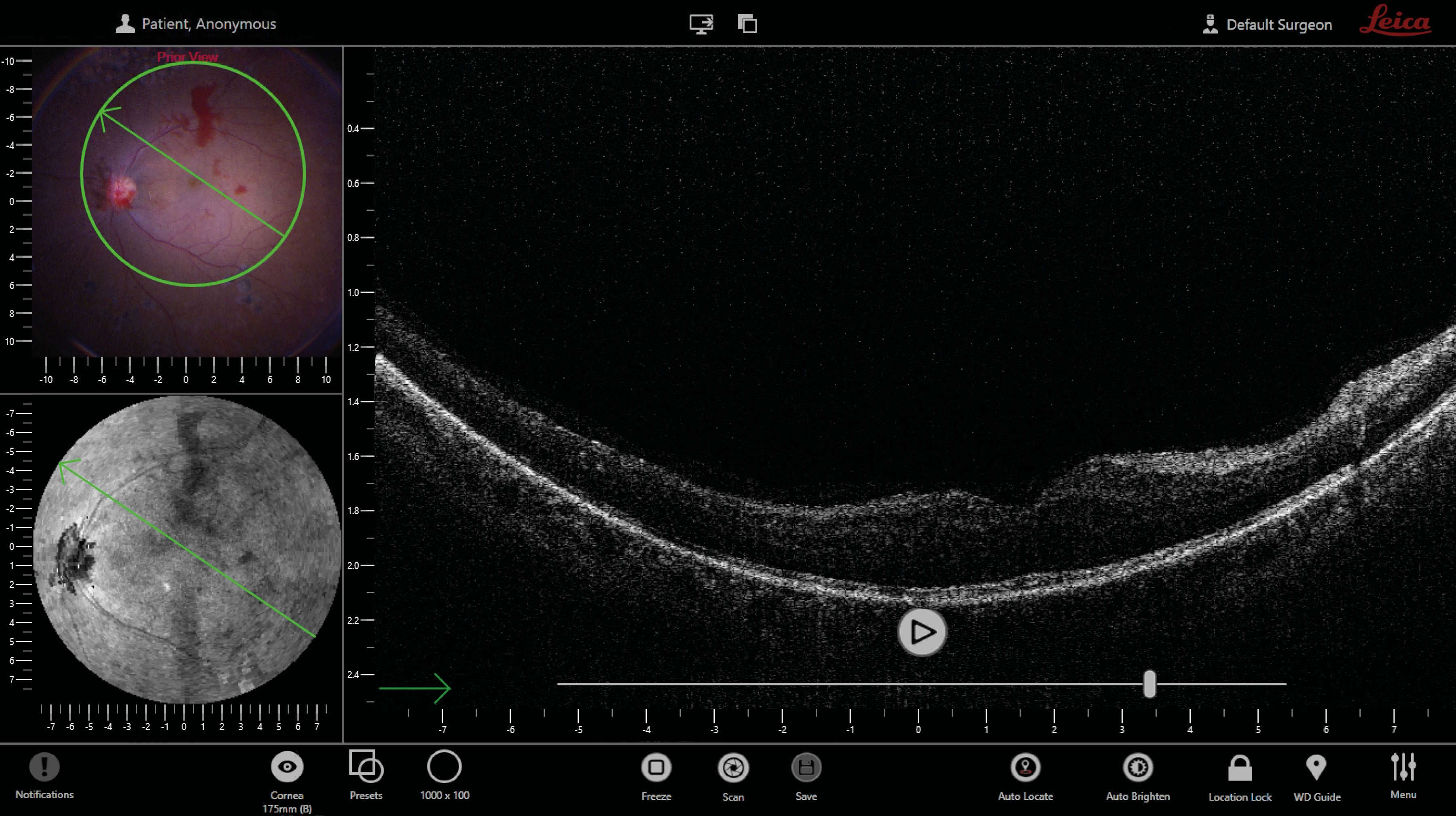 OCT quad view: surgical view (1); en face view (2); OCT b-scan view (3).