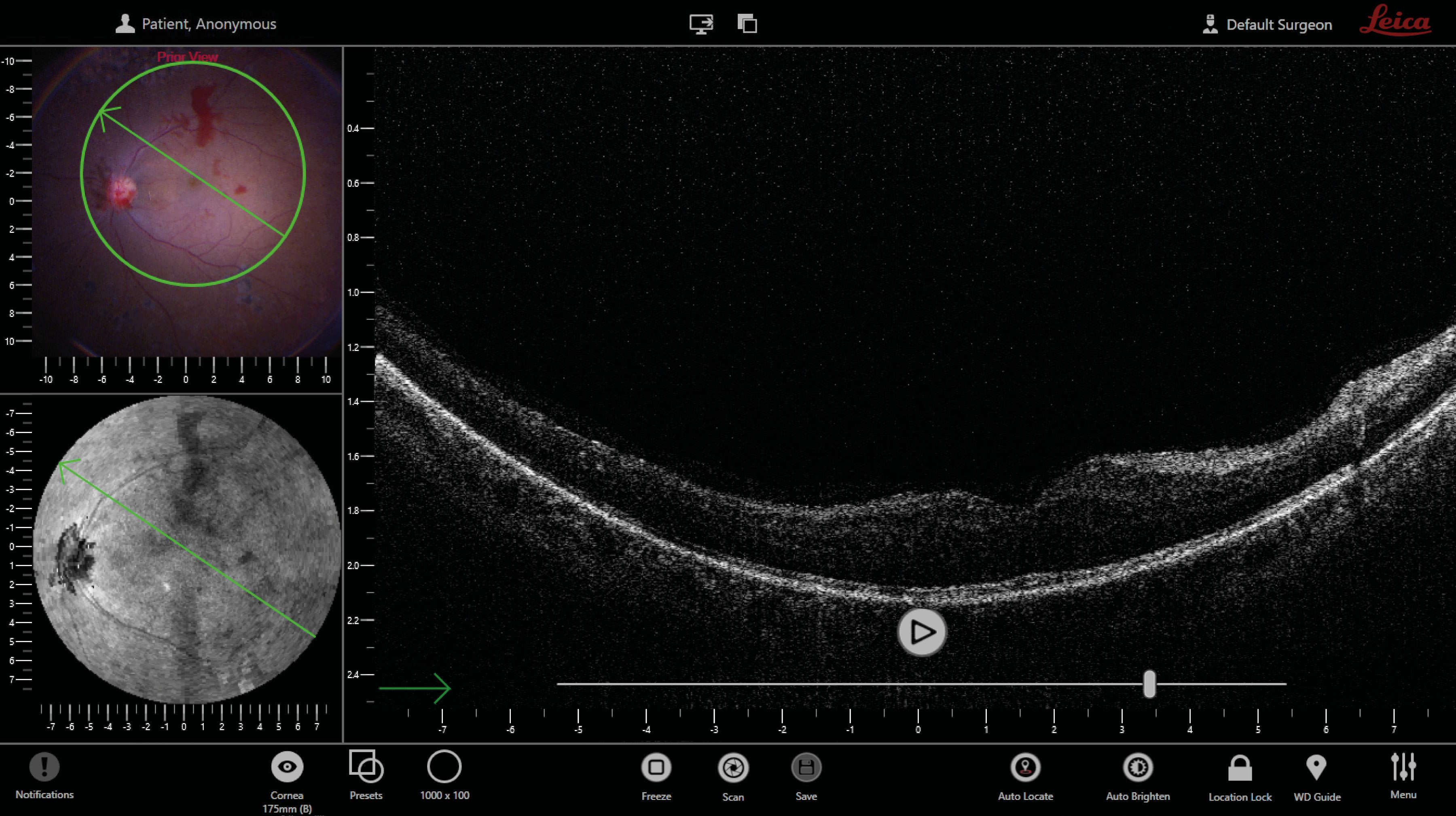 [Translate to chinese:] OCT quad view: surgical view (1); en face view (2); OCT b-scan view (3).