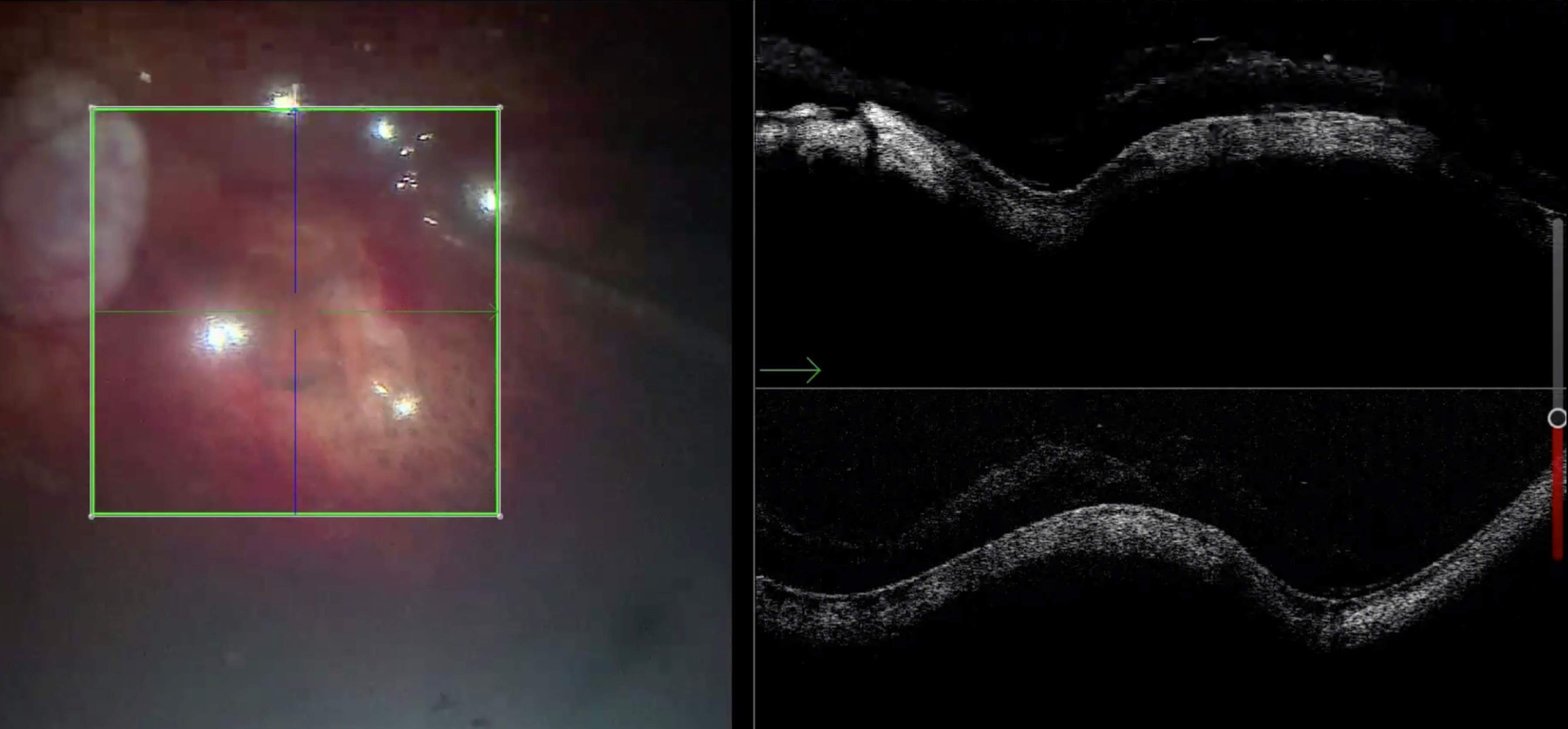 [Translate to chinese:] Same case as in Fig 14, viewed under air. The details are difficult to observe through the microscope. Intraoperative OCT confirms the correct position of the macular hole on the buckle.